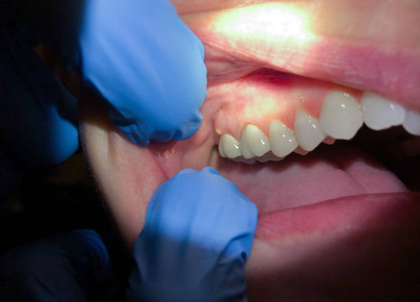 Best Emergency Treatment for Dental Infections or Abscesses in Warrensville Heights, OH